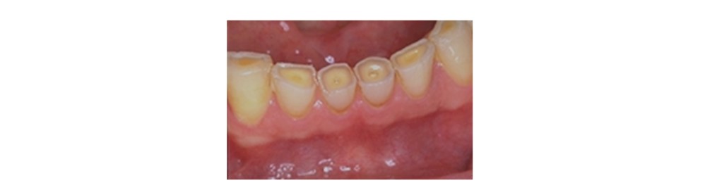 Bruxisme - Grincement des dents - Traitement - Le Studio Dentaire